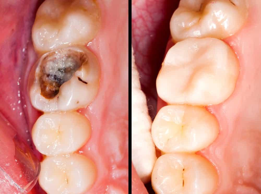 Damage To Teeth Or Dental Restorations