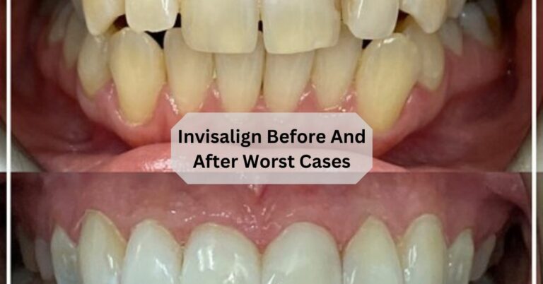 Invisalign Before And After Worst Cases
