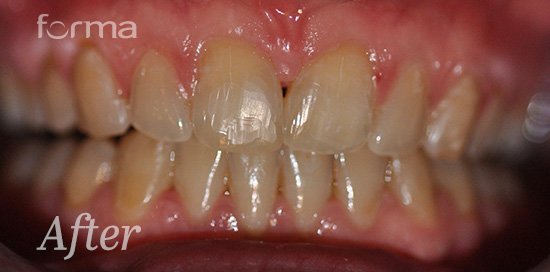 What To Expect Before Starting Invisalign Treatment