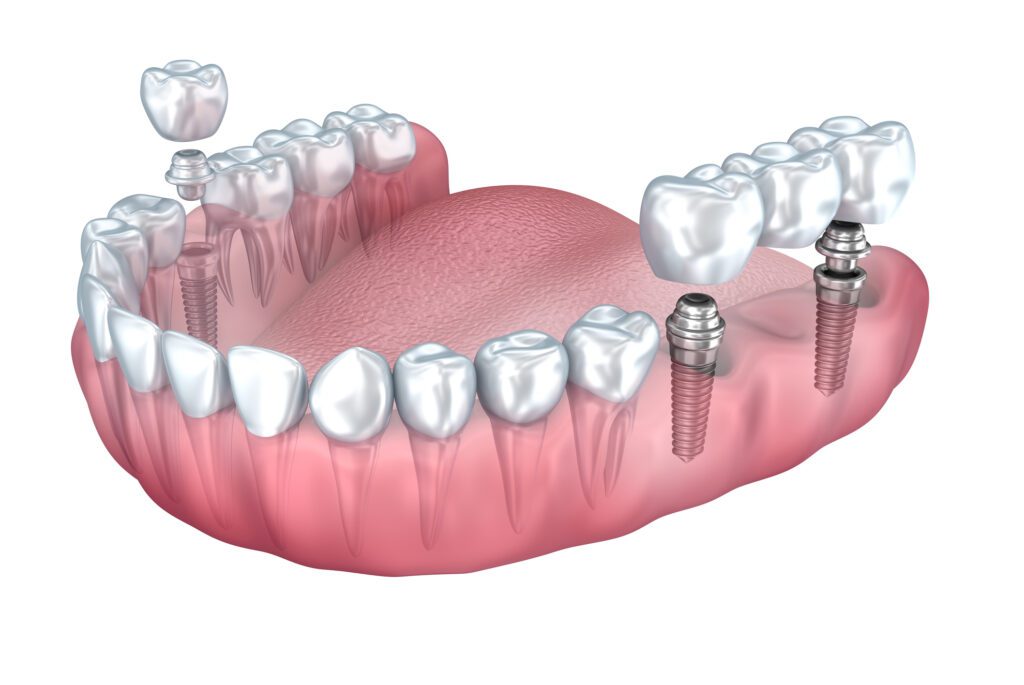 Affordable Alternatives To Single Tooth Implants