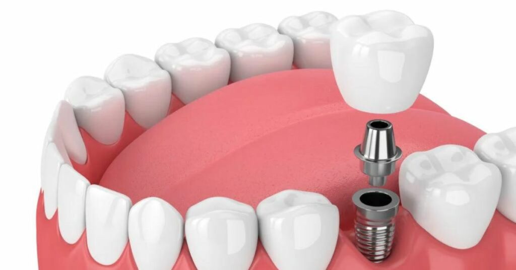 Factors Affecting Single Tooth Implant Cost