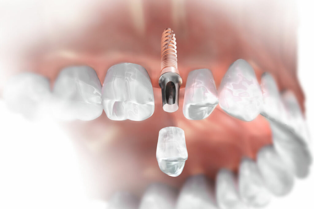 Tips For Reducing Single Tooth Implant Cost