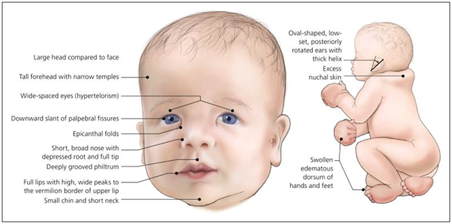 Common Features And Symptoms Of Noonan Syndrome: